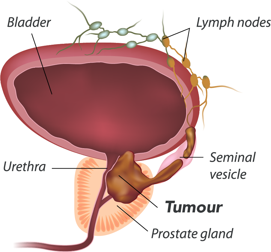 Prostate Cancer